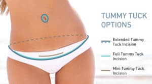 Tummy Tuck (Abdominoplasty) Fayetteville, Raleigh, NC