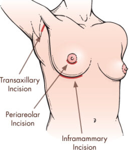 Breast Implant Size and Breast Cup Size Fayetteville Raleigh Wilmington NC