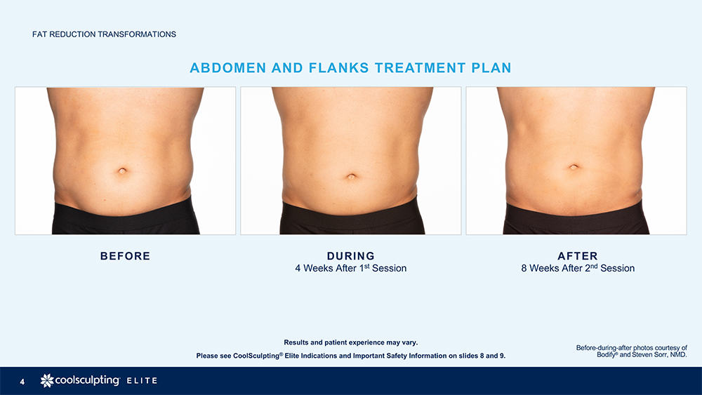 CoolSculpting Love Handles, Coolsculpting flanks before and after