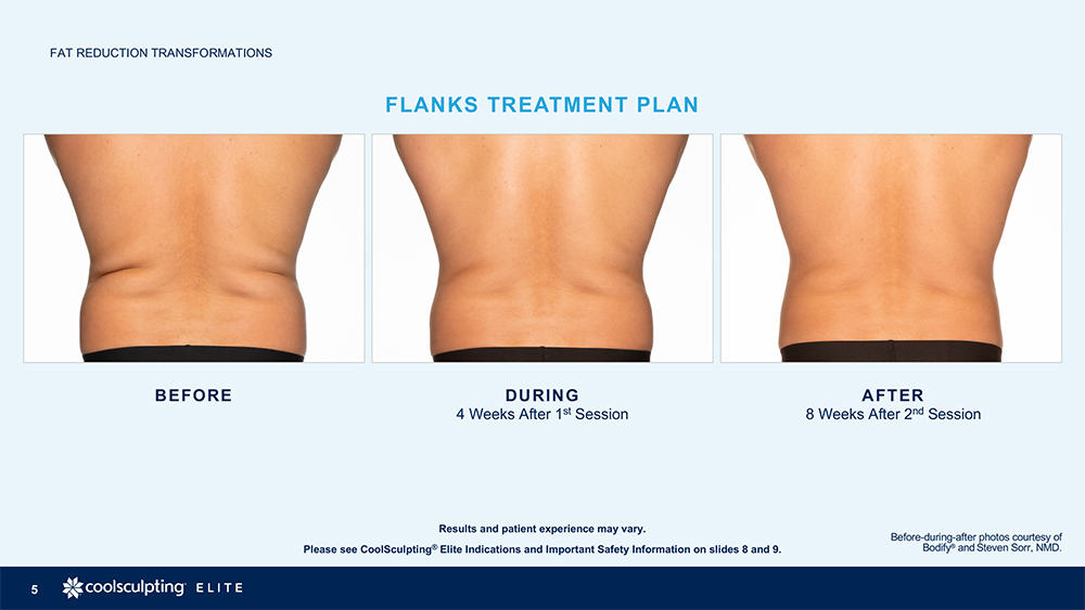 CoolSculpting® consultations are now available at Raleigh Plastic