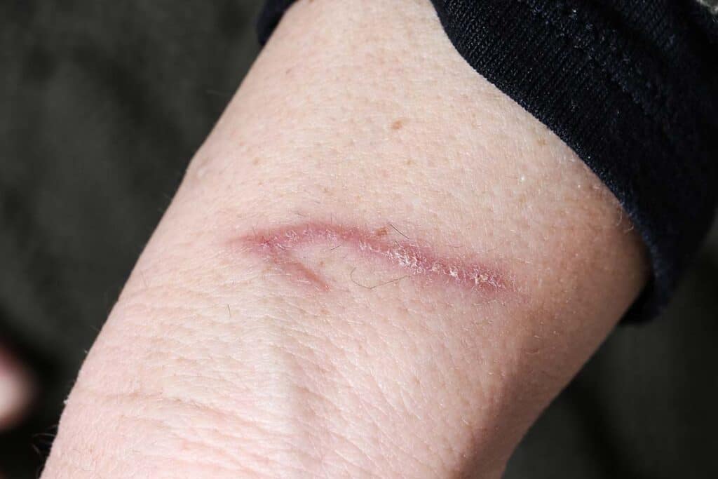 scar treatment